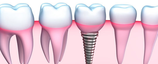 How Dental Implants Have Become the Most Popular Form of Restorative Dentistry