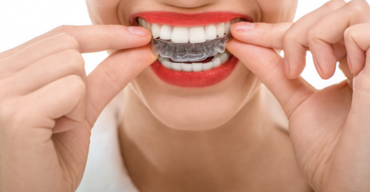 The Benefits of Adult Braces