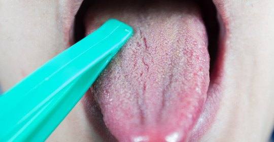 What is brown tongue and how is it treated?